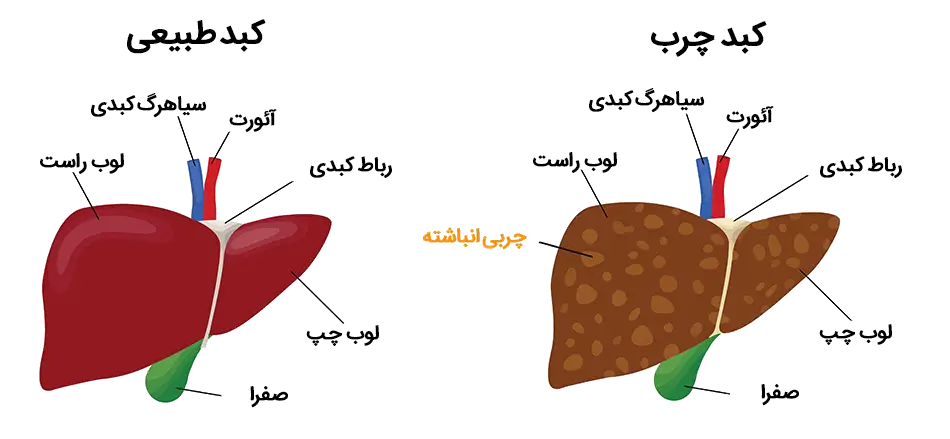 علائم کبد چرب